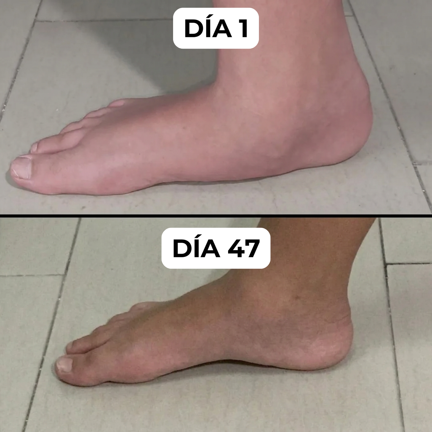 InFoot® - Plantillas Ortopédicas BioForm