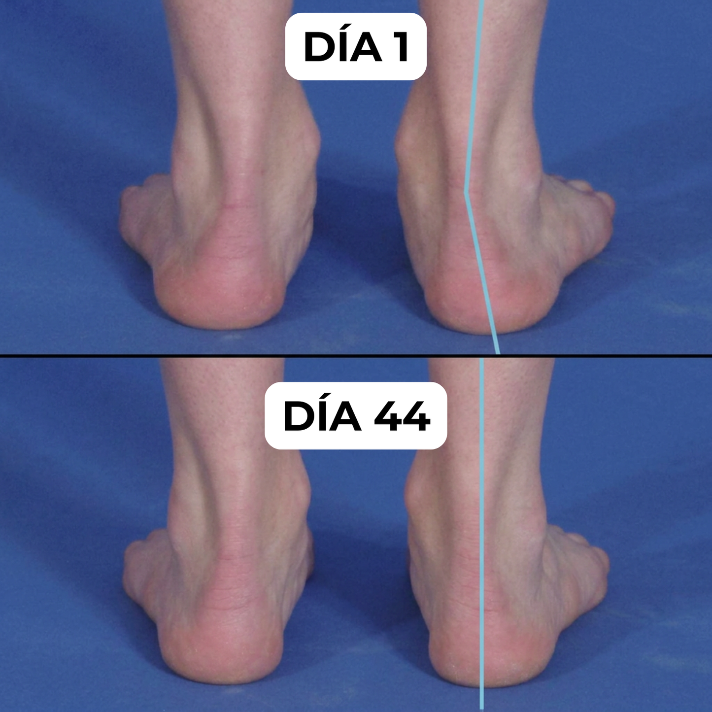 InFoot® - Plantillas Ortopédicas BioForm