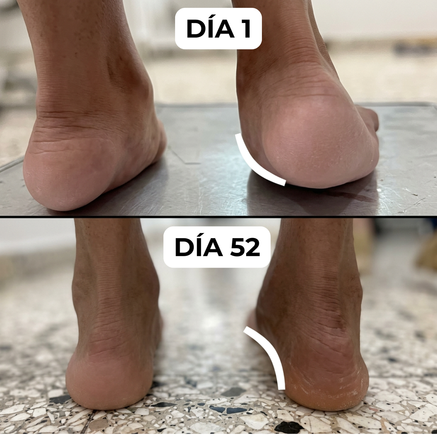 InFoot® - Plantillas Ortopédicas BioForm